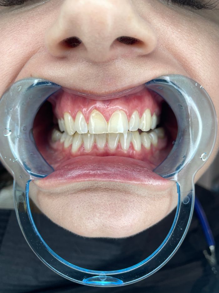 Before: stained, discolored teeth